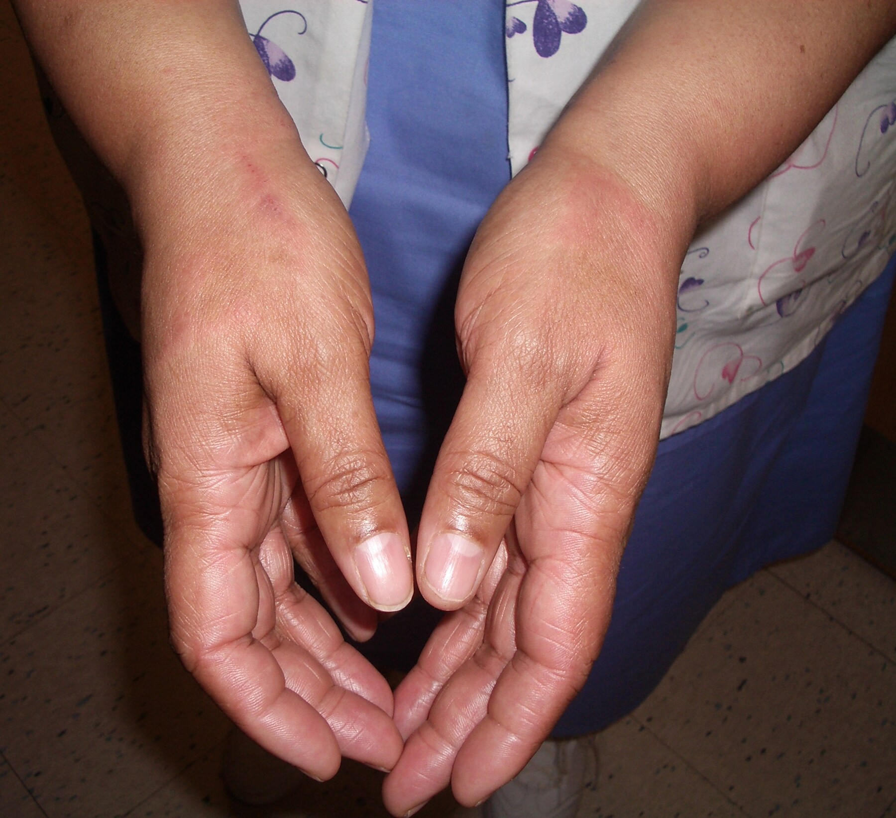 Contact Dermatitis On Hands Pictures