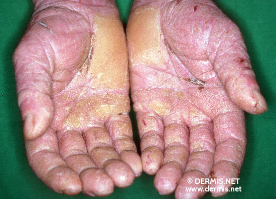 Contact Dermatitis On Hands Pictures