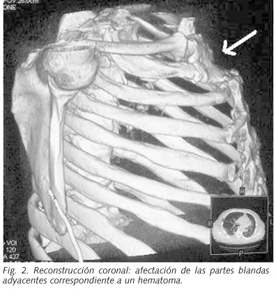 Esternon Inflamado Causas