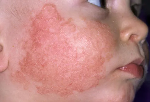 Face Skin Rashes In Adults