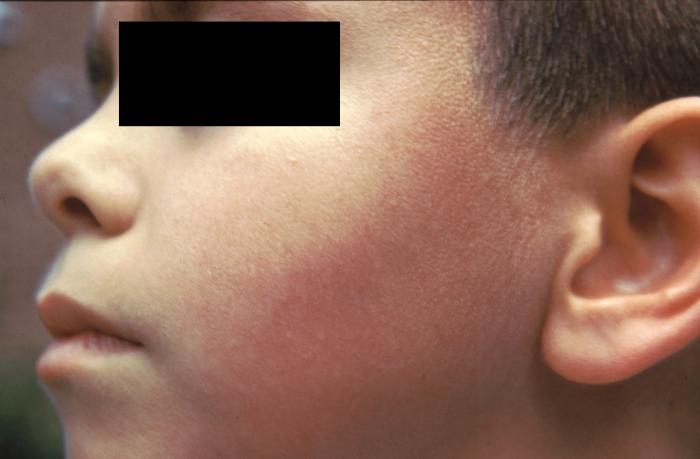 Face Skin Rashes In Adults