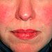 Facial Skin Rashes In Adults