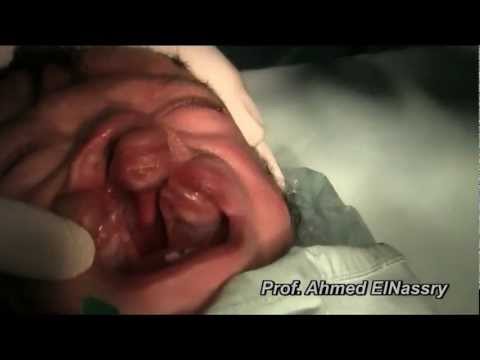 Feeding Bottles For Babies With Cleft Palate