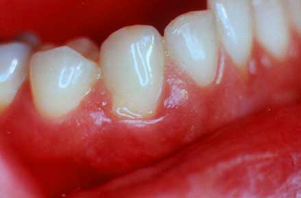 Healthy Gums Pictures