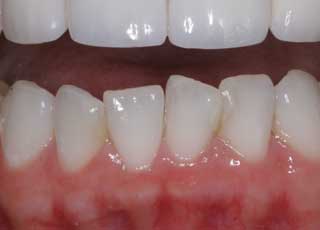 Healthy Gums Pictures