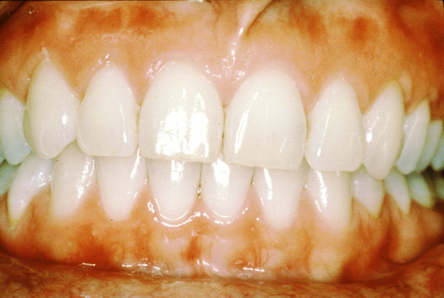 Healthy Gums Pictures