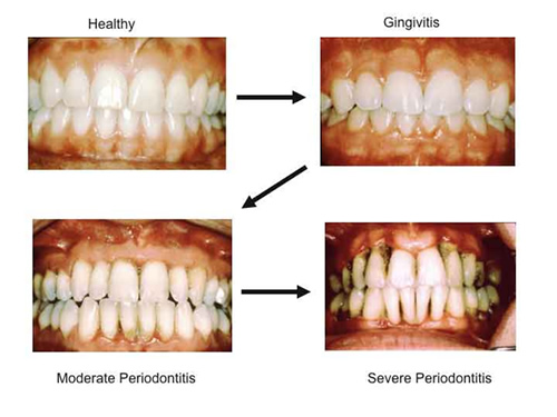 Healthy Gums Pictures