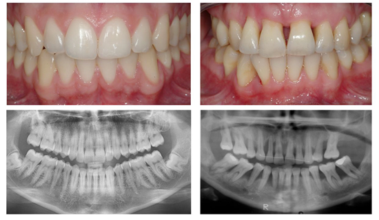 Healthy Gums Vs Gum Disease