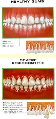 Healthy Gums Vs Gum Disease