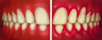 Healthy Gums Vs Gum Disease