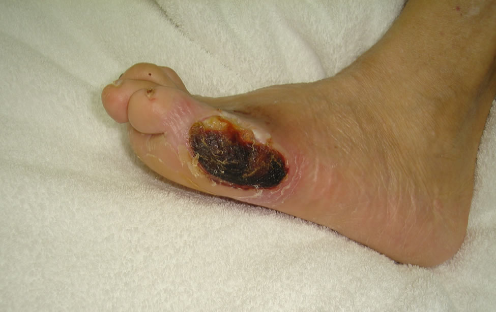 Heel Pressure Ulcer Prevention