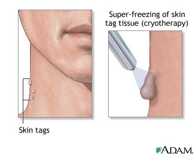 How To Remove Skin Tags On Neck At Home