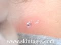 How To Remove Skin Tags On Neck At Home