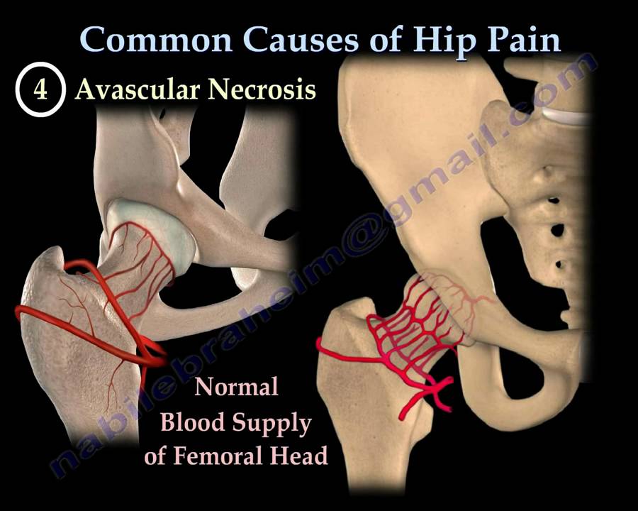 Joint Pain Leg And Hip