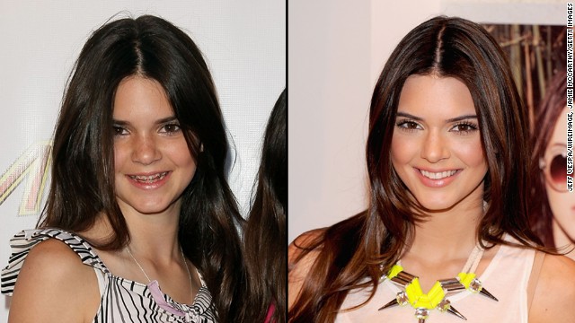 Kendall Jenner Now And Then