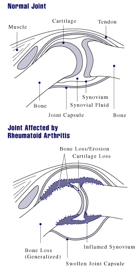 Leg Joint Pain Treatment