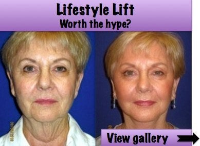 Lifestyle Lift Before And After Photos