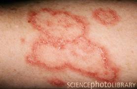 Lupus Skin Rashes On Arms