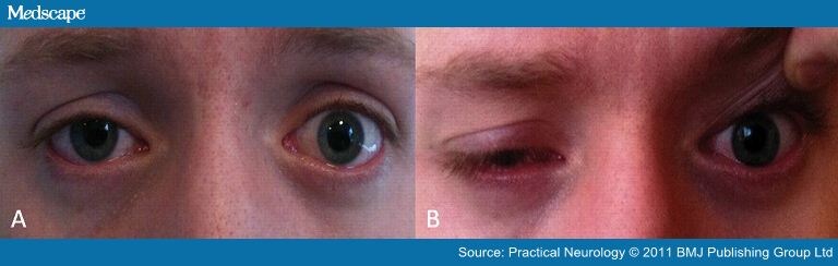 Mild Ptosis Treatment