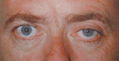 Mild Ptosis Treatment