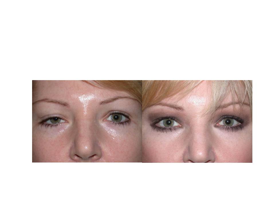 Mild Ptosis Treatment