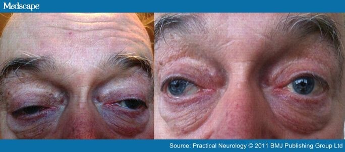 Mild Ptosis Treatment