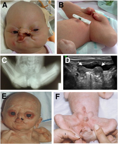 Multiple Pterygium Syndrome