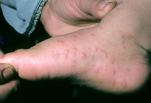 Non Itchy Skin Rashes In Adults