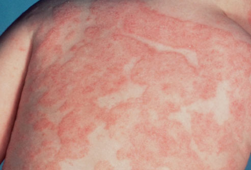 Non Itchy Skin Rashes In Adults