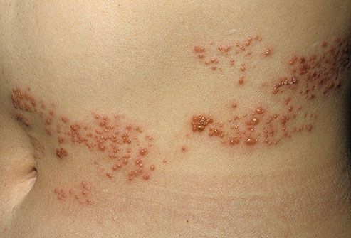 Non Itchy Skin Rashes In Adults