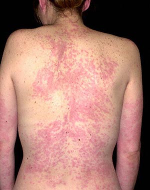 Non Itchy Skin Rashes In Adults