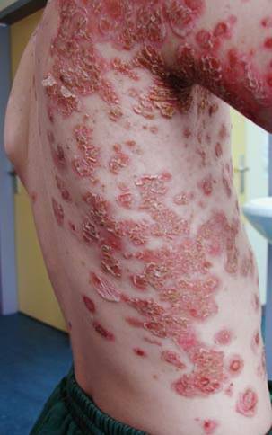 Non Itchy Skin Rashes In Adults