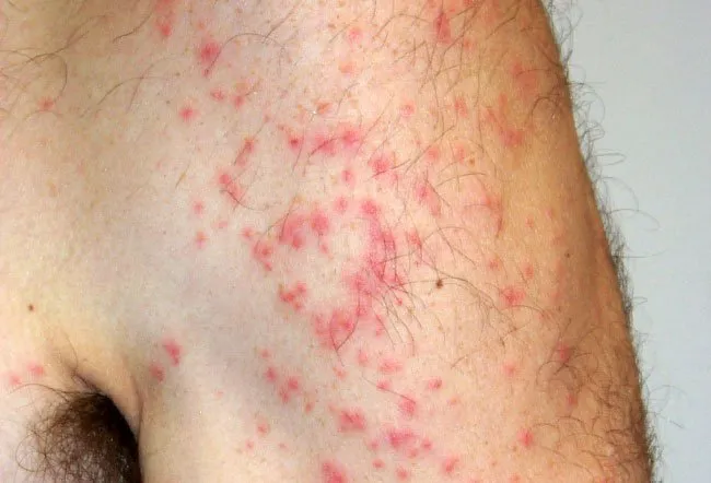 Non Itchy Skin Rashes In Adults