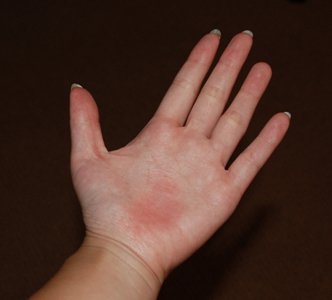 Non Itchy Skin Rashes In Adults