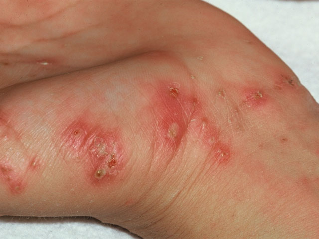 Non Itchy Skin Rashes In Adults