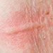 Non Itchy Skin Rashes In Adults