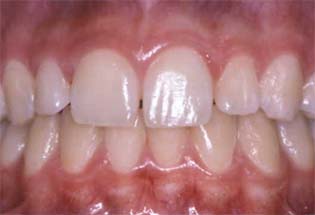 Pictures Of Healthy Gums And Teeth