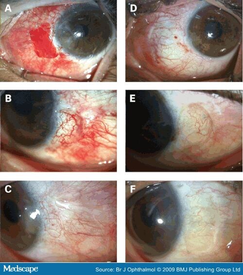 Post Pterygium Surgery