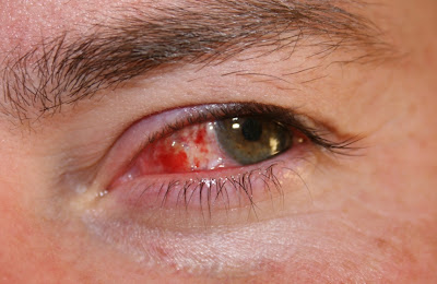 Post Pterygium Surgery