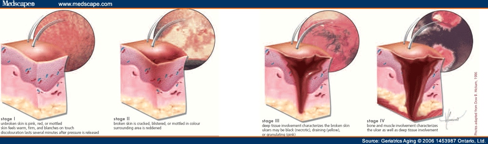 Pressure Sores Grades