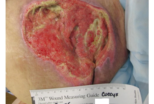 Pressure Sores Grades