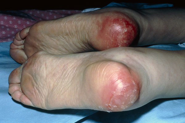 Pressure Sores Images