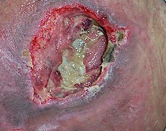 Pressure Sores Images