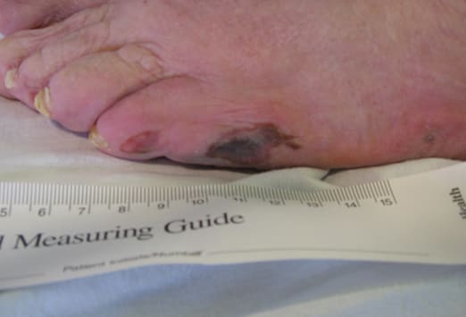 Pressure Sores On Toes