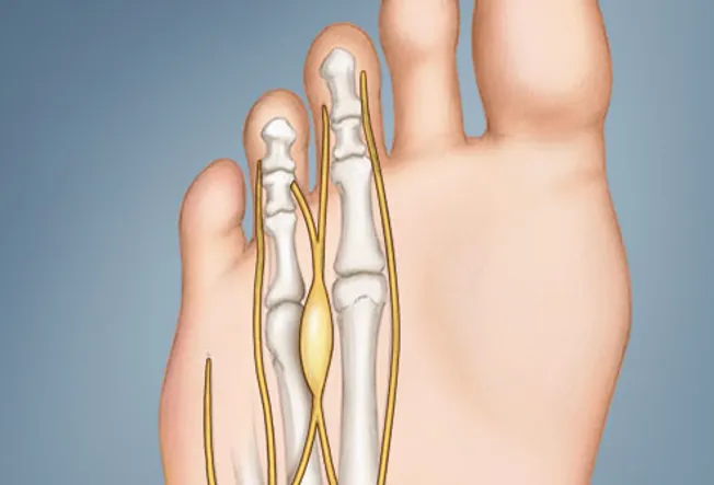 Pressure Sores On Toes