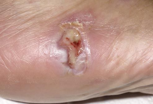 Pressure Sores On Toes