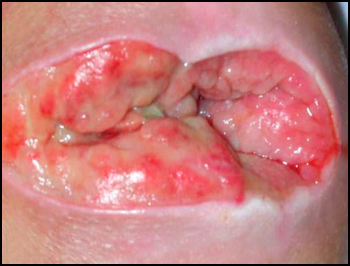 Pressure Sores Pictures