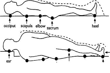 Pressure Sores Pictures