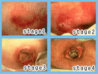 Pressure Sores Pictures