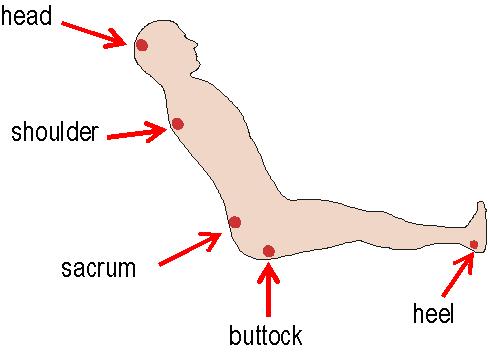 Pressure Sores Stages